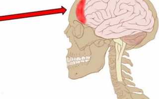Когда болит лобная часть головы