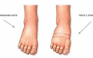 При беременности сильно болят ноги и спина в ранних сроках