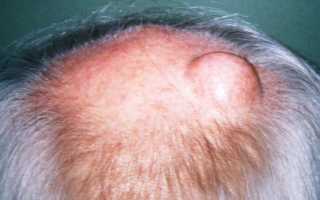 Шишка растет на голове и болит голова