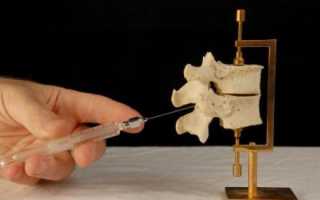 При эпидуральной анестезии болит спина место укола