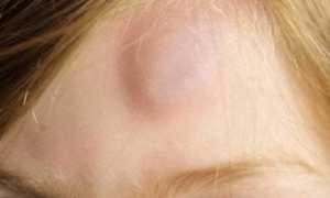 Слева на голове шишка болит