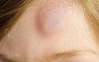 Слева на голове шишка болит