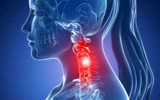 Защемило нерв в шее при этом болит голова