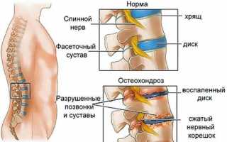 Долго болит если защемило нерв в спине отдает в ногу