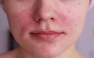 Болит голова красные щеки температура