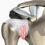 тендобурсит