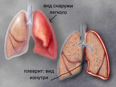Если болит справа в боку и отдает в спину