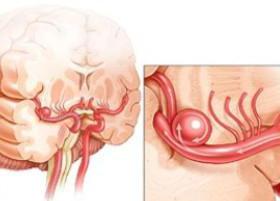 пульсация в затылочной части головы
