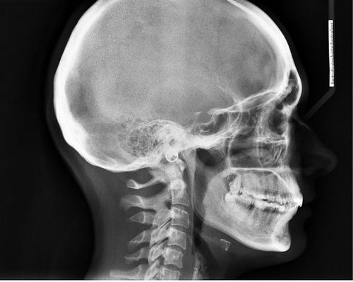 Очень сильно болит голова когда встаю