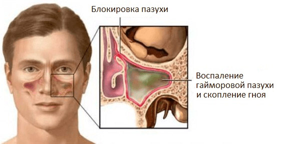 Сопли с кровью и болит голова
