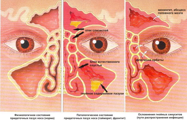 Сопли с кровью и болит голова