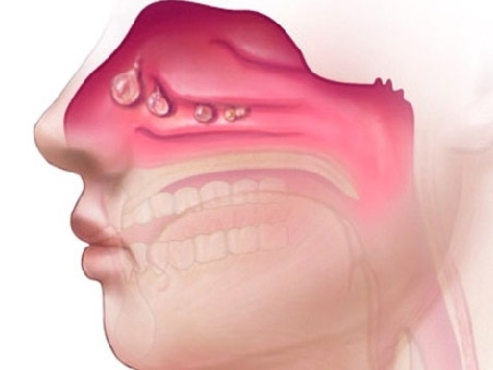 Сопли с кровью и болит голова