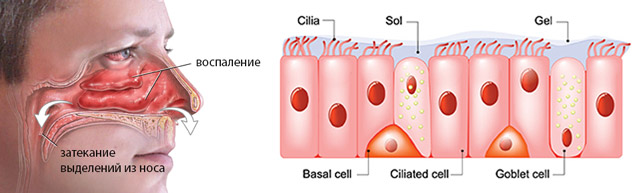 Сопли с кровью и болит голова
