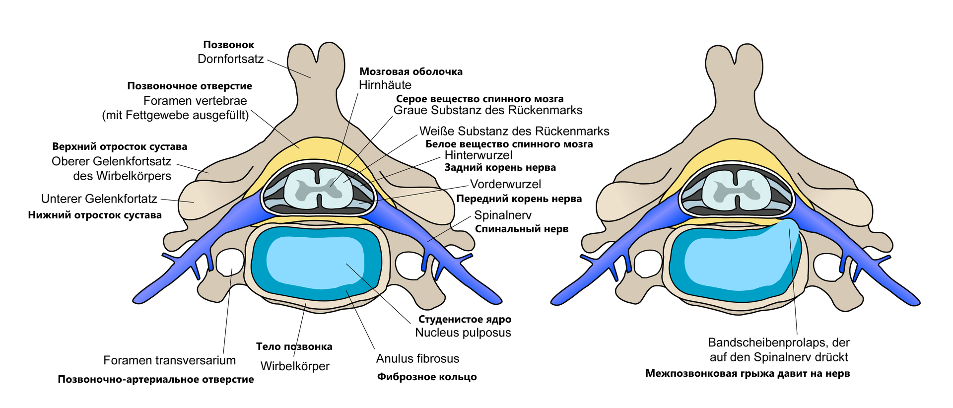 Межпозвоночная грыжа