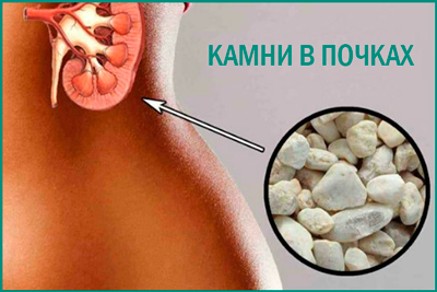 Мочекаменная болезнь: причины