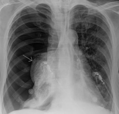 Если болит справа в боку и отдает в спину