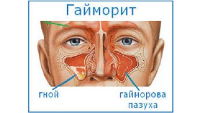 При температуре может болеть спина
