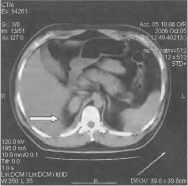 Если болит справа в боку и отдает в спину
