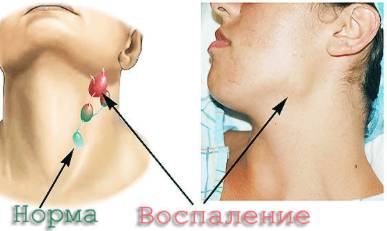 При температуре может болеть спина