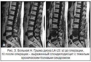 Рис. 3. Больная Н. Грыжа диска L4-L5: а) до операции,б) после операции – выраженный спондилодисцит с тяжелымхроническим болевым синдромом Рис. 3. Больная Н. Грыжа диска L4-L5: а) до операции,б) после операции – выраженный спондилодисцит с тяжелымхроническим болевым синдромом