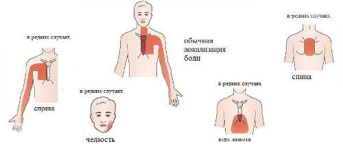 Боль при стенокардии
