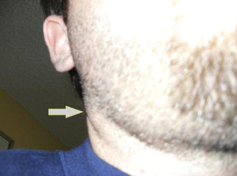 гнойный шейный лимфаденит