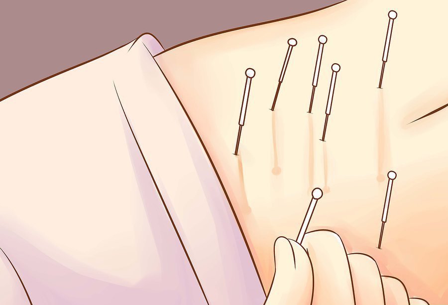 Иглорефлексотерапия