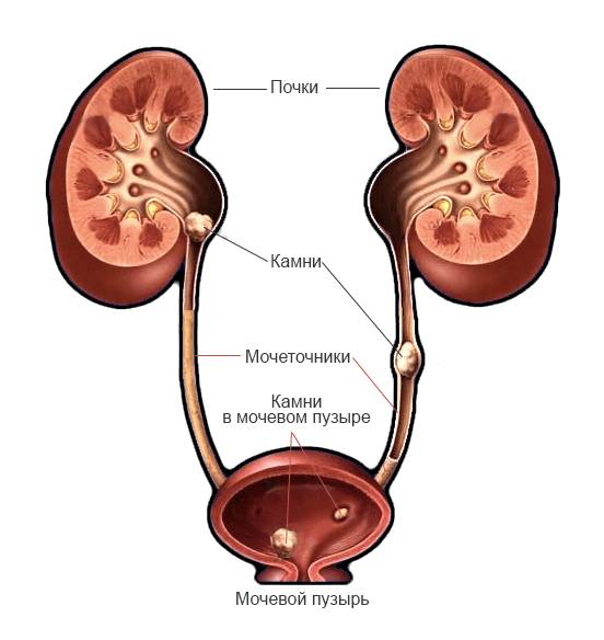 Мочекаменная болезнь