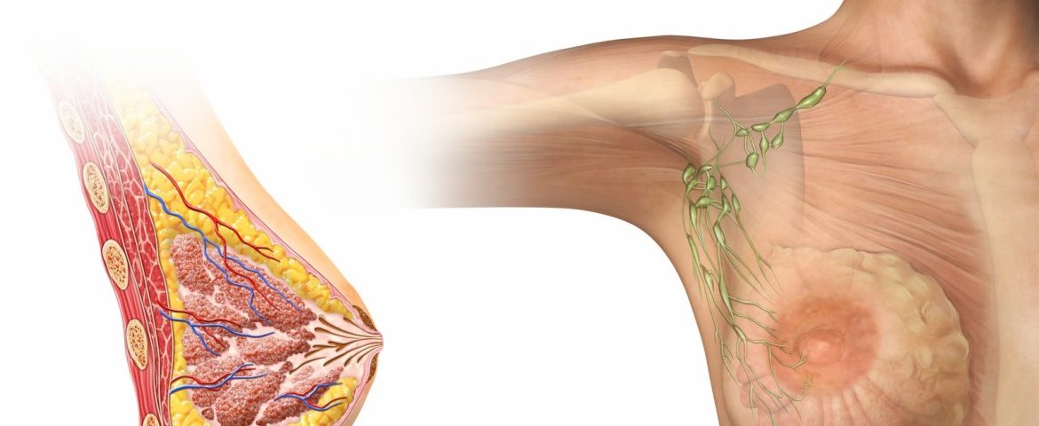 Межреберная невралгия