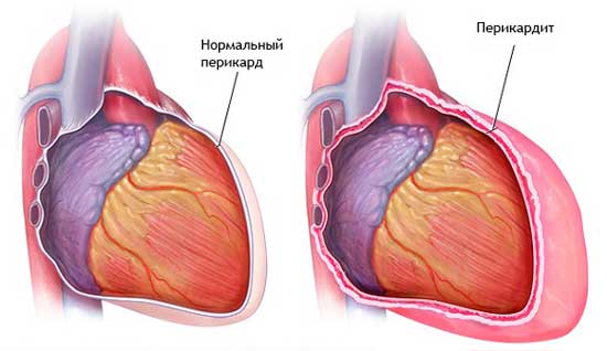 перикардит