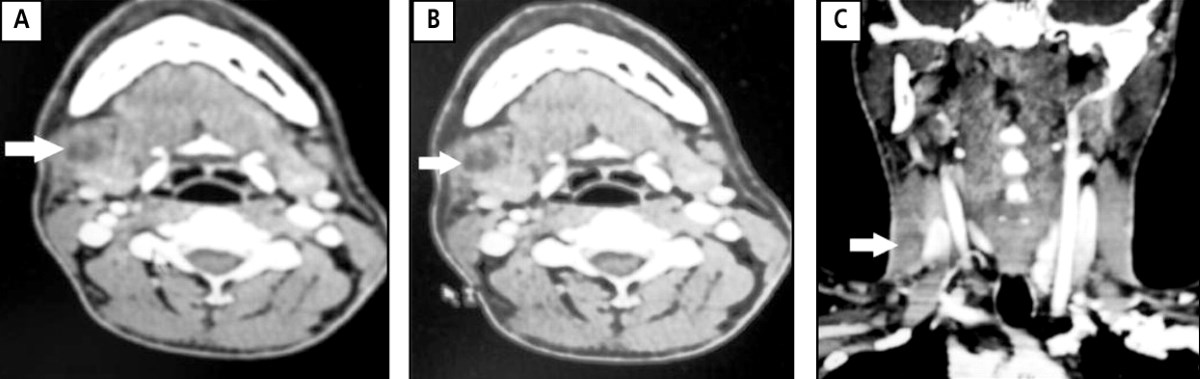 томографическое сканирование подчелюстной железы
