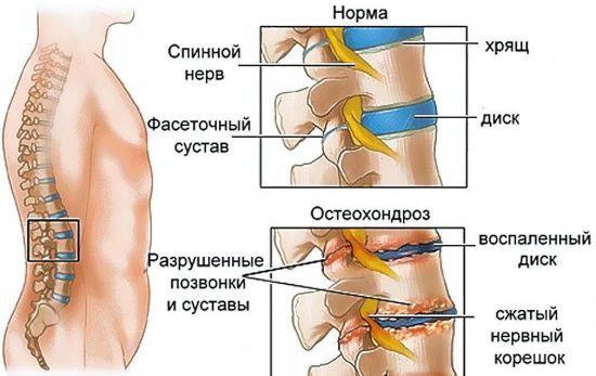 Ущемление нерва в позвоночнике